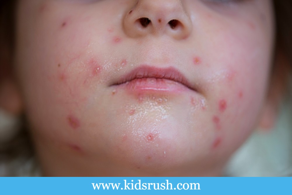 Causes of pimples on baby skin