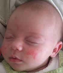 Causes of pimples on baby's skin