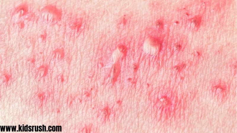 Herpes zoster symptoms in children