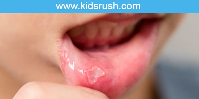 Canker sores in children: how to treat them?