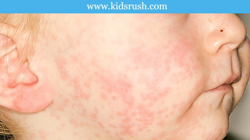 6-most-common-diseases-in-nursery-school-children-kidsrush