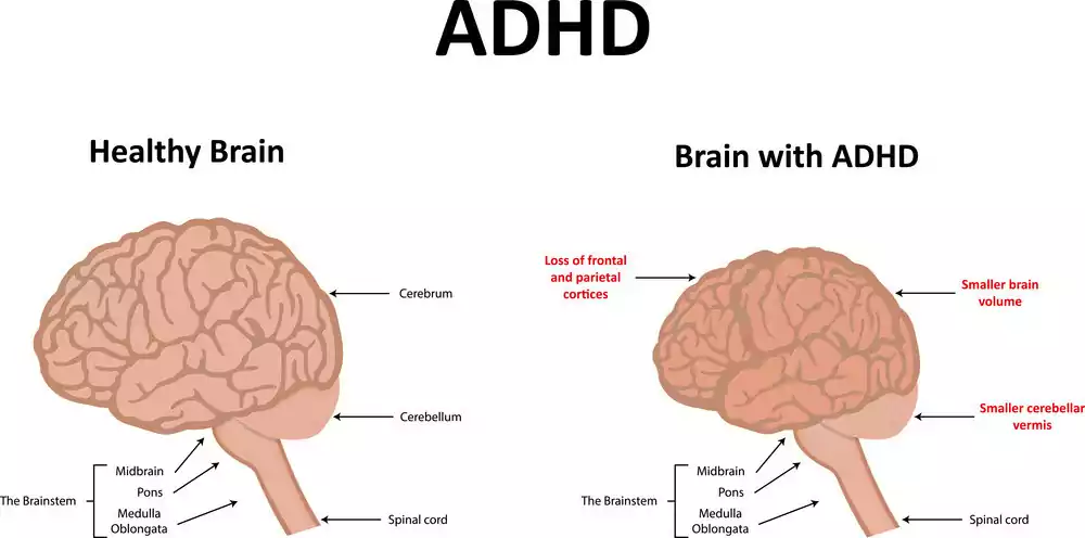 What are the causes of ADHD in children?