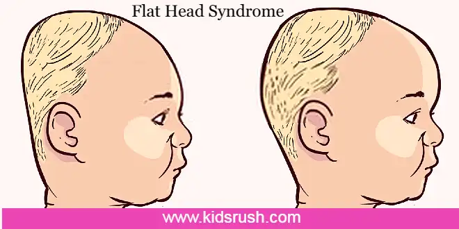 flat head syndrome in babies