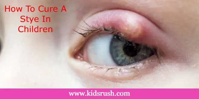 How To Cure A Stye In Children