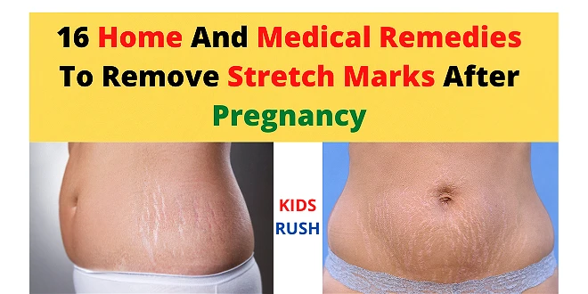Stretch Marks After Pregnancy