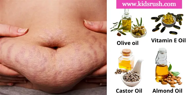 use of castor oil, almond oil, vitamin e oil, and olive oil to remove stretch marks after pregnancy