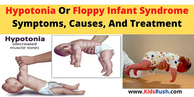 Hypotonia Or Floppy Infant Syndrome