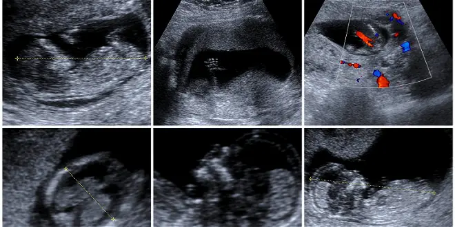 Fetal development at 9 months of pregnancy