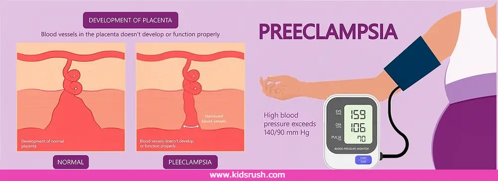 Postpartum hypertension1