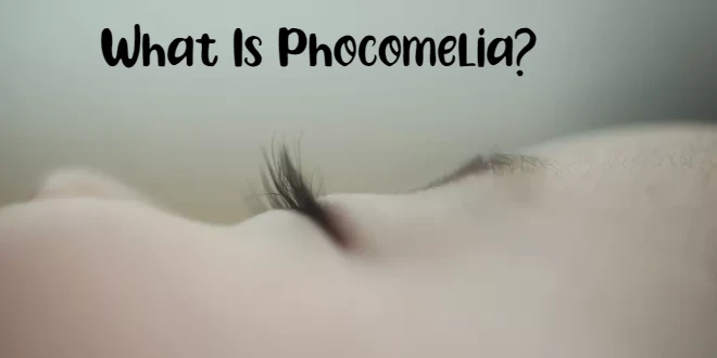 What Is Phocomelia?
