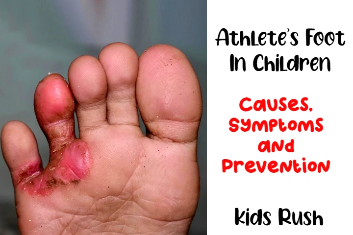 Athlete's Foot In Children