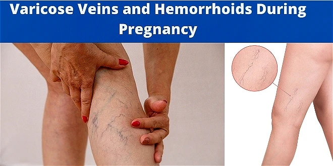 Varicose Veins and Hemorrhoids During Pregnancy
