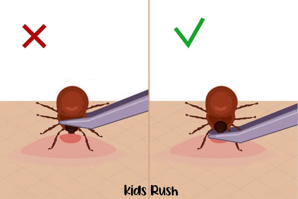 Tick Bites In Children